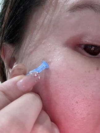 这个一次性的,可比大头针好用太多了!关键还便宜!老爱手欠挤包包的,就用这种比头发丝还细的次抛,干净卫生还方便#女生必备#痘痘肌#清洁工具#我捡到宝了#种草