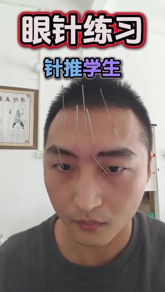 今天操作下眼针脸针😂#原创作品 #针灸学习 #眼睛疲劳 #科普 #传统文化