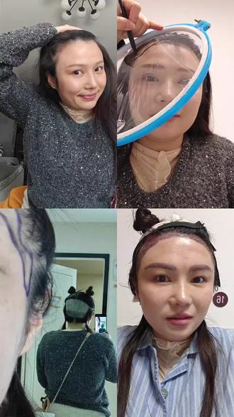 我会不择手段得到想要的一切,在我热烈的35岁#记录植发过程 #变美 #发际线种植 #发际线 #种植眉毛视频全过程