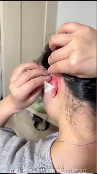 精灵耳耳贴真的有用吗? #抖出健康知识宝藏#我的年度健康盘点#精灵耳#埋线精灵耳#医学科普