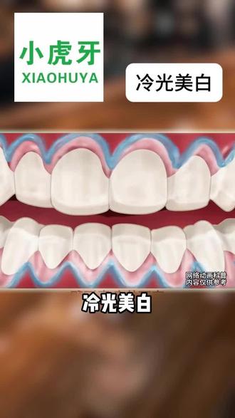 你觉得冷光美白怎么样?#武陟 #武陟小虎牙口腔 #爱牙护牙 #口腔健康