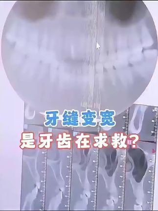#牙龈萎缩 #牙龈萎缩怎么办 #牙龈萎缩专用 #牙龈萎缩黑三角 #牙龈萎缩牙周炎