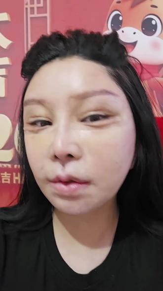 一次面吸,三次溶脂针,不如一次1470微光净馒术 #馒化 #馒化修复 #面吸 #溶脂针
