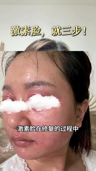 激素脸修复哪有那么难! #皮肤逆袭过程 #激素脸 #激素脸修复 #激素脸怎么办