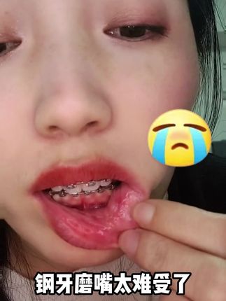 戴钢牙磨嘴真的好痛啊!!!#钢牙磨嘴 #颗粒蜡 #皓齿舒 #口腔护理 #钢牙妹