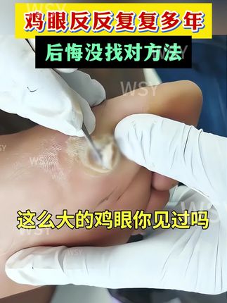 鸡眼反反复复,后悔没早点知道这个方法#鸡眼怎么去除 #鸡眼去除小妙招 #鸡眼 #脚上长鸡眼怎么办 #鸡眼怎么造成的