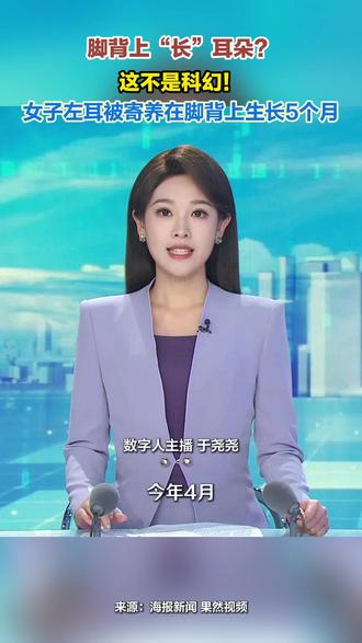 脚背上“长”耳朵? 这不是科幻! 女子左耳被寄养在脚背上生长5个月#医学 #科技 #科技改变生活 #就医 #医学科普