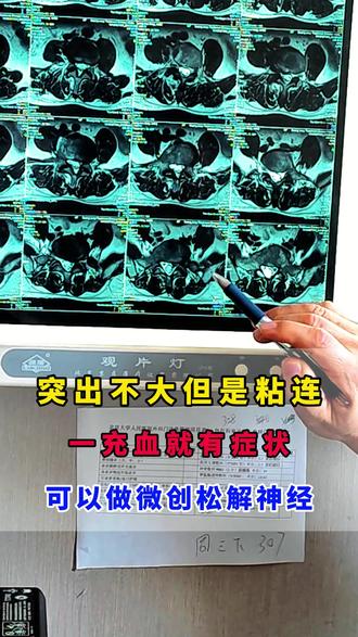 突出不大但是粘连一充血就有症状可以做微创松解神经