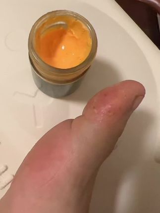 #脚气用什么药 #脚气 #脚气脚趾缝糜烂 #脚臭