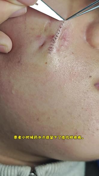 🔹本例14岁小姑娘因幼时盲目药水点痣,遗留痘坑样疤痕,多次激光治疗均效果不佳✨我院为其采用LBD超减张切缝联合精细缝合手术,术后恢复理想。⚠️在此郑重提醒大家,面部色素痣切勿选择药水点痣,应前往正规医疗机构,根据情况选择手术切缝或规范激光治疗💡若药水点痣后遗留疤痕,一定要及时到院就诊修复!
#疤痕切缝 #拆线 #美容缝合 #医生日常 #美容外科