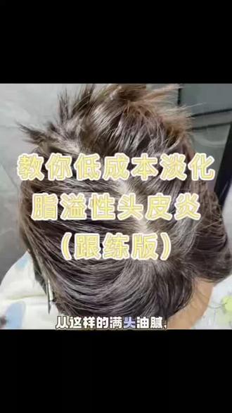 脂溢性头皮炎,能帮一个是一个!#头发护理