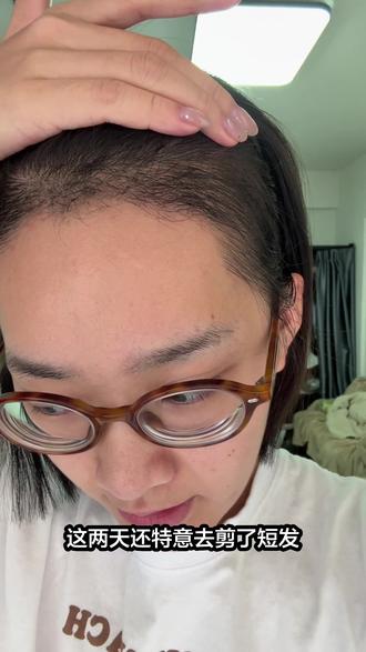 130天啦!猛地一看真的变化很大….#植发 #发际线 #发际线种植 #养发 #脱发