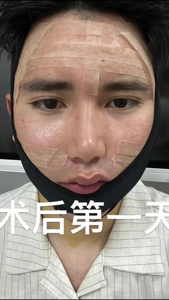 为了变美,肿成猪头也无所谓 嗨,今天是皮下分离+脂肪填充术后第一天。脸被绷带和胶布‘封印’着,能感觉到轻微的肿胀和紧绷感,不过医生说这是正常恢复过程~目前吃喝需要慢慢来,但心里对恢复后的样子还挺期待的!接下来会乖乖听医嘱,按时护理,记录每天的恢复变化,希望肿胀快快退散,大家可以持续关注#皮下分离 #脂肪填充#痘痘#痘坑 #整容