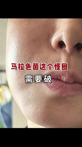 脂皮马拉色菌疹子 #脂溢性皮炎#玫瑰痤疮#脸上发红干燥起皮怎么办 #脸上泛红发痒怎么办 #闭口粉刺