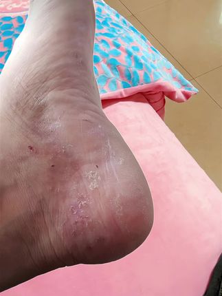 #可爱的小脚丫 #脚丫子 #脚干脚裂 #手足护理 #强烈推荐