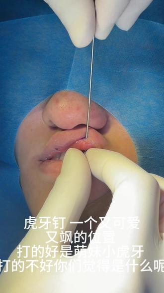 看看你们的虎牙钉#虎牙钉#穿孔#大连穿孔#大连穿孔师#大连穿孔店