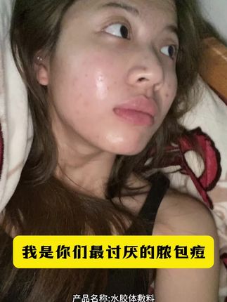 如果你还在烦恼长痘痘,不妨试试这款医用水胶体痘痘贴!#医用#无菌#痘痘贴#好物推荐🔥 #干净又卫生