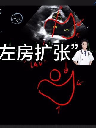 左心房扩张 #兽医#心脏超声