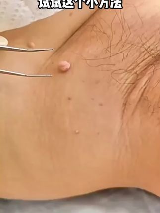 身上的小肉粒一定要重视,快试试这款药膏 在家轻松处理皮肤问题#皮肤管理#hpv #扁平疣 #扁平疣祛除 #丝状疣祛除 #小瘊子