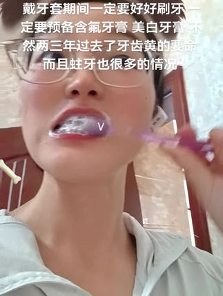戴牙套期间一定要好好刷牙 一定要预备含氟牙膏 美白牙膏 不然两三年过去了牙齿黄的要命 而且蛀牙也很多的情况 #牙齿正畸 #整牙历程 #创作者扶持计划 #拔牙