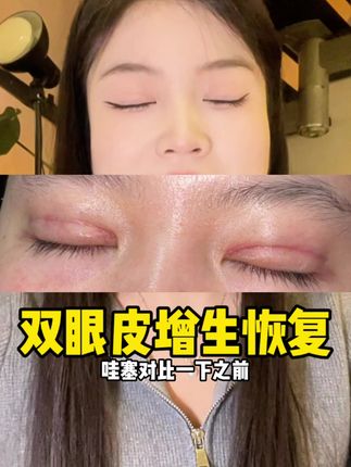 芭克是真好用#芭克去疤膏 #芭克硅凝胶 #芭克