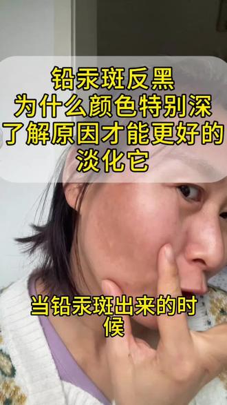 铅汞斑反黑为什么那么黑,为什么不让做技术,这就是答案#祛斑 #祛斑的真实视频 #原相机 #养肤
