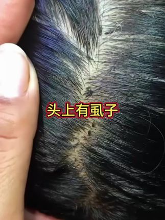 维真园百部酊去虱洗发水#头虱洗发水 #头虱 #虱子 #虱子卵 #消除虱子卵的小妙招