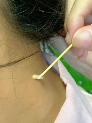 #点痣前和点痣后 #脖子上的小肉粒怎么祛除