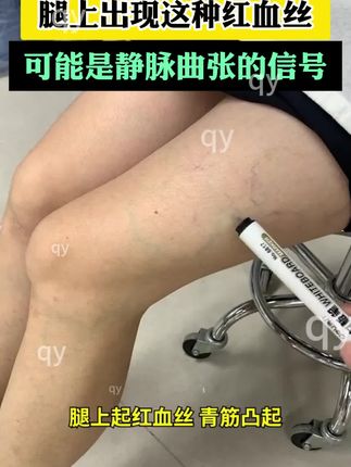 真的超出你的预期,你不妨就相信你我一次#静脉曲张 #静脉曲张微创 #静脉曲张怎么办 #静脉曲张老烂腿 #静脉曲张老烂腿