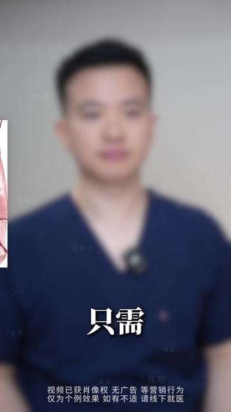 不开刀不放假体 终身维持 轻松解决下巴后缩 #鼻基底凹陷#面中扁平#下巴后缩#自体骨再生#骨再生