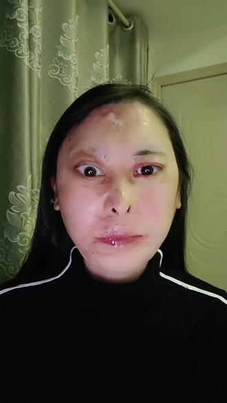 关于脸是怎么回事。实在不值一提,只是很多小伙伴比较好奇,所以就索性一次说清楚啦~#被火烧伤 #毁容