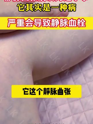 静脉曲张别以为是小事,千万不要拖#静脉曲张怎么办 #静脉曲张怎么改善 #静脉曲张的最快消除方法 #红血丝 #青筋凸起