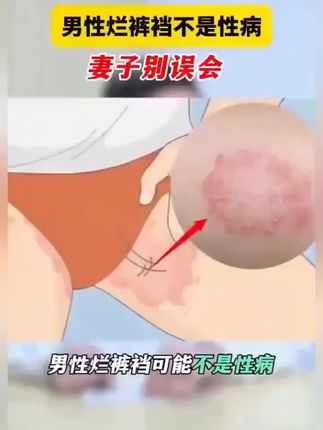 #好物推荐🔥 大腿长了这样的圆形红斑,你越挠,它就越缠着你!#大腿内侧痒 #真菌感染 #医学科普 #医学科普仅供参考如有不适请线下就医