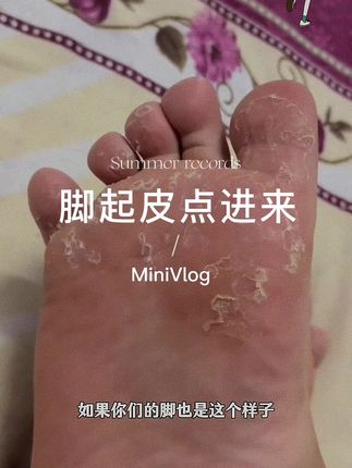 哪里干裂抹哪里#云南真菌王 #花鼓子好用